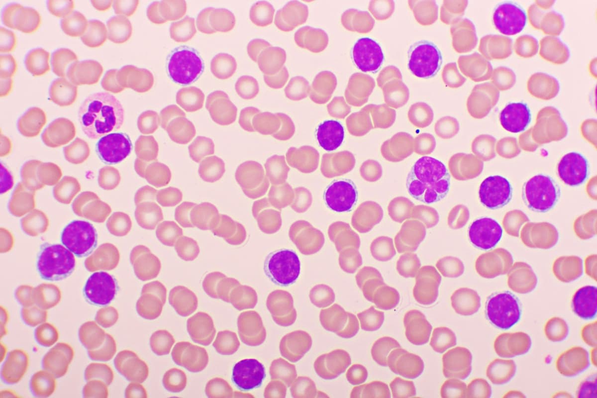Implementasi Model CNN SqueezeNet dalam Klasifikasi Penyakit Leukemia Limfoblastik Akut